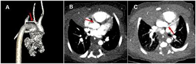 Case Report: Neonatal Complex Congenital Heart Disease With Anomalous Origin of the Left Coronary Artery From the Right Pulmonary Artery: Analysis of Missed Diagnosis and Improvement Procedures